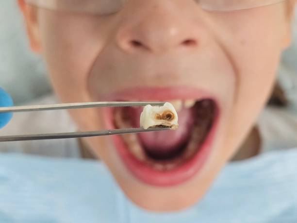Best Same-Day Emergency Dentist in Woodworth, LA